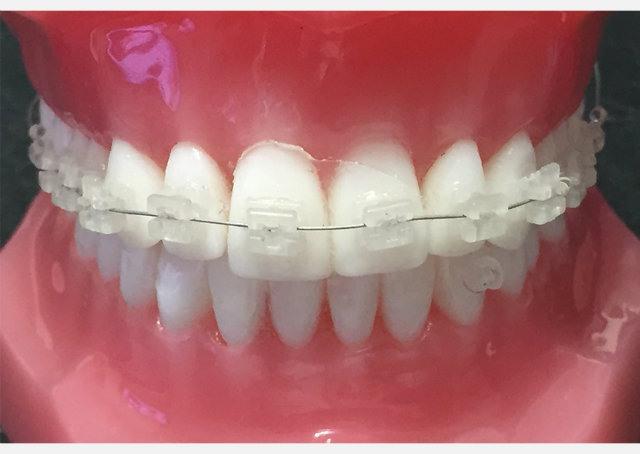 Clínica brasileira cria aparelho autoligável e estético 40% mais barato que modelo tradicional